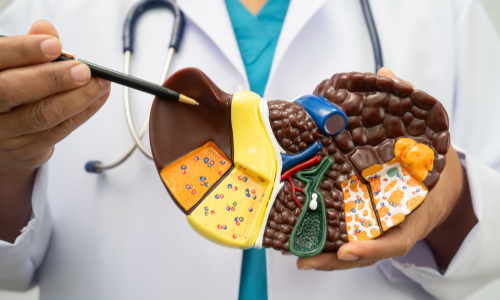 Fatty Liver